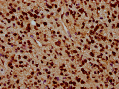 IHC image of CSB-PA010429OA91nacHU diluted at 1:5 and staining in paraffin-embedded human glioma performed on a Leica BondTM system. After dewaxing and hydration, antigen retrieval was mediated by high pressure in a citrate buffer (pH 6.0). Section was blocked with 10% normal goat serum 30min at RT. Then primary antibody (1% BSA) was incubated at 4°C overnight. The primary is detected by a biotinylated secondary antibody and visualized using an HRP conjugated SP system. IHC image of CSB-PA010429OA91nacHU diluted at 1:5 and staining in paraffin-embedded human glioma performed on a Leica BondTM system. After dewaxing and hydration, antigen retrieval was mediated by high pressure in a citrate buffer (pH 6.0). Section was blocked with 10% normal goat serum 30min at RT. Then primary antibody (1% BSA) was incubated at 4°C overnight. The primary is detected by a biotinylated secondary antibody and visualized using an HRP conjugated SP system.
