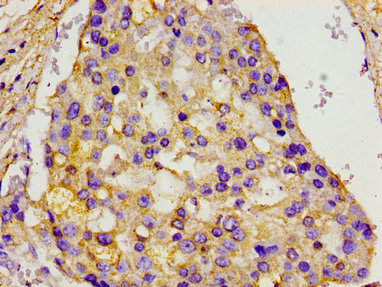Immunohistochemistry of paraffin-embedded human breast cancer using CSB-PA013592LA01HU at dilution of 1:100 Immunohistochemistry of paraffin-embedded human breast cancer using CSB-PA013592LA01HU at dilution of 1:100