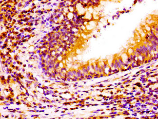 Immunohistochemistry of paraffin-embedded human lung cancer using CSB-PA015512LA01HU at dilution of 1:100