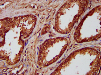 IHC image of CSB-PA015847LA01HU diluted at 1:300 and staining in paraffin-embedded human prostate cancer performed on a Leica BondTM system. After dewaxing and hydration, antigen retrieval was mediated by high pressure in a citrate buffer (pH 6.0). Section was blocked with 10% normal goat serum 30min at RT. Then primary antibody (1% BSA) was incubated at 4°C overnight. The primary is detected by a biotinylated secondary antibody and visualized using an HRP conjugated SP system. IHC image of CSB-PA015847LA01HU diluted at 1:300 and staining in paraffin-embedded human prostate cancer performed on a Leica BondTM system. After dewaxing and hydration, antigen retrieval was mediated by high pressure in a citrate buffer (pH 6.0). Section was blocked with 10% normal goat serum 30min at RT. Then primary antibody (1% BSA) was incubated at 4°C overnight. The primary is detected by a biotinylated secondary antibody and visualized using an HRP conjugated SP system.