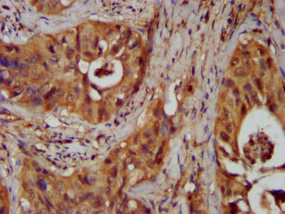 IHC image of CSB-PA015847LA01HU diluted at 1:300 and staining in paraffin-embedded human cervical cancer performed on a Leica BondTM system. After dewaxing and hydration, antigen retrieval was mediated by high pressure in a citrate buffer (pH 6.0). Section was blocked with 10% normal goat serum 30min at RT. Then primary antibody (1% BSA) was incubated at 4°C overnight. The primary is detected by a biotinylated secondary antibody and visualized using an HRP conjugated SP system.