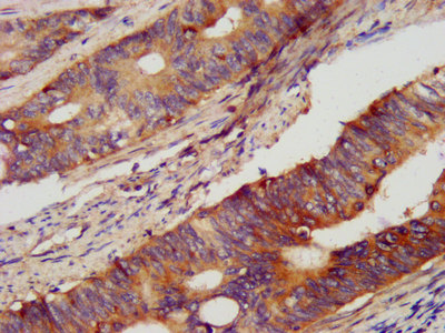 IHC image of CSB-PA017642LA01HU diluted at 1:400 and staining in paraffin-embedded human colon cancer performed on a Leica BondTM system. After dewaxing and hydration, antigen retrieval was mediated by high pressure in a citrate buffer (pH 6.0). Section was blocked with 10% normal goat serum 30min at RT. Then primary antibody (1% BSA) was incubated at 4°C overnight. The primary is detected by a biotinylated secondary antibody and visualized using an HRP conjugated SP system.
