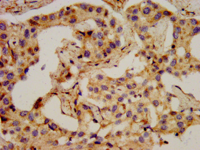 IHC image of CSB-PA017642LA01HU diluted at 1:400 and staining in paraffin-embedded human liver cancer performed on a Leica BondTM system. After dewaxing and hydration, antigen retrieval was mediated by high pressure in a citrate buffer (pH 6.0). Section was blocked with 10% normal goat serum 30min at RT. Then primary antibody (1% BSA) was incubated at 4°C overnight. The primary is detected by a biotinylated secondary antibody and visualized using an HRP conjugated SP system.