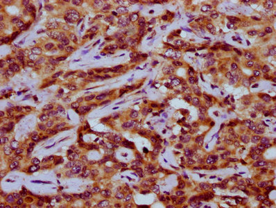 IHC image of CSB-PA017795LA01HU diluted at 1:200 and staining in paraffin-embedded human liver cancer performed on a Leica BondTM system. After dewaxing and hydration, antigen retrieval was mediated by high pressure in a citrate buffer (pH 6.0). Section was blocked with 10% normal goat serum 30min at RT. Then primary antibody (1% BSA) was incubated at 4°C overnight. The primary is detected by a biotinylated secondary antibody and visualized using an HRP conjugated SP system.