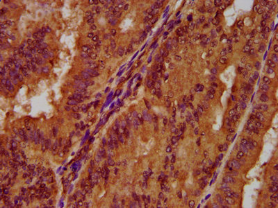 IHC image of CSB-PA017862LA01HU diluted at 1:300 and staining in paraffin-embedded human endometrial cancer performed on a Leica BondTM system. After dewaxing and hydration, antigen retrieval was mediated by high pressure in a citrate buffer (pH 6.0). Section was blocked with 10% normal goat serum 30min at RT. Then primary antibody (1% BSA) was incubated at 4°C overnight. The primary is detected by a biotinylated secondary antibody and visualized using an HRP conjugated SP system. IHC image of CSB-PA017862LA01HU diluted at 1:300 and staining in paraffin-embedded human endometrial cancer performed on a Leica BondTM system. After dewaxing and hydration, antigen retrieval was mediated by high pressure in a citrate buffer (pH 6.0). Section was blocked with 10% normal goat serum 30min at RT. Then primary antibody (1% BSA) was incubated at 4°C overnight. The primary is detected by a biotinylated secondary antibody and visualized using an HRP conjugated SP system.