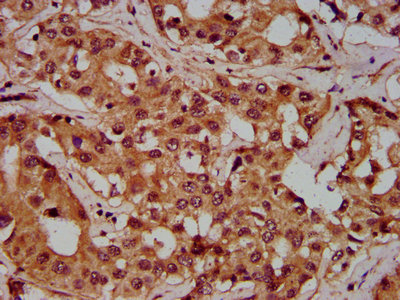 IHC image of CSB-PA017862LA01HU diluted at 1:300 and staining in paraffin-embedded human liver cancer performed on a Leica BondTM system. After dewaxing and hydration, antigen retrieval was mediated by high pressure in a citrate buffer (pH 6.0). Section was blocked with 10% normal goat serum 30min at RT. Then primary antibody (1% BSA) was incubated at 4°C overnight. The primary is detected by a biotinylated secondary antibody and visualized using an HRP conjugated SP system.