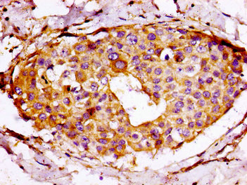 IHC image of CSB-PA020476LA01HU diluted at 1:100 and staining in paraffin-embedded human breast cancer performed on a Leica BondTM system. After dewaxing and hydration, antigen retrieval was mediated by high pressure in a citrate buffer (pH 6.0). Section was blocked with 10% normal goat serum 30min at RT. Then primary antibody (1% BSA) was incubated at 4°C overnight. The primary is detected by a biotinylated secondary antibody and visualized using an HRP conjugated SP system. IHC image of CSB-PA020476LA01HU diluted at 1:100 and staining in paraffin-embedded human breast cancer performed on a Leica BondTM system. After dewaxing and hydration, antigen retrieval was mediated by high pressure in a citrate buffer (pH 6.0). Section was blocked with 10% normal goat serum 30min at RT. Then primary antibody (1% BSA) was incubated at 4°C overnight. The primary is detected by a biotinylated secondary antibody and visualized using an HRP conjugated SP system.