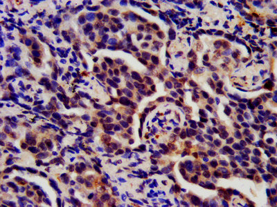 IHC image of CSB-PA020641HA01HU diluted at 1:200 and staining in paraffin-embedded human lung cancer performed on a Leica BondTM system. After dewaxing and hydration, antigen retrieval was mediated by high pressure in a citrate buffer (pH 6.0). Section was blocked with 10% normal goat serum 30min at RT. Then primary antibody (1% BSA) was incubated at 4°C overnight. The primary is detected by a biotinylated secondary antibody and visualized using an HRP conjugated SP system. IHC image of CSB-PA020641HA01HU diluted at 1:200 and staining in paraffin-embedded human lung cancer performed on a Leica BondTM system. After dewaxing and hydration, antigen retrieval was mediated by high pressure in a citrate buffer (pH 6.0). Section was blocked with 10% normal goat serum 30min at RT. Then primary antibody (1% BSA) was incubated at 4°C overnight. The primary is detected by a biotinylated secondary antibody and visualized using an HRP conjugated SP system.