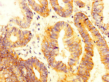 IHC image of CSB-PA021383LA01HU diluted at 1:300 and staining in paraffin-embedded human colon cancer performed on a Leica BondTM system. After dewaxing and hydration, antigen retrieval was mediated by high pressure in a citrate buffer (pH 6.0). Section was blocked with 10% normal goat serum 30min at RT. Then primary antibody (1% BSA) was incubated at 4°C overnight. The primary is detected by a biotinylated secondary antibody and visualized using an HRP conjugated SP system.
