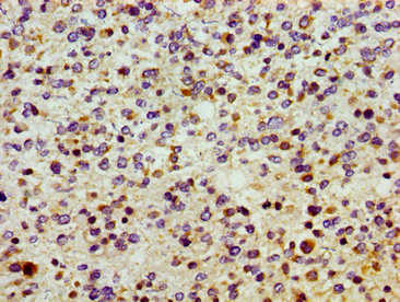 Immunohistochemistry of paraffin-embedded human glioma using CSB-PA021844LA01HU at dilution of 1:100 Immunohistochemistry of paraffin-embedded human glioma using CSB-PA021844LA01HU at dilution of 1:100
