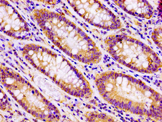 IHC image of CSB-PA021871LA01HU diluted at 1:100 and staining in paraffin-embedded human colon cancer performed on a Leica BondTM system. After dewaxing and hydration, antigen retrieval was mediated by high pressure in a citrate buffer (pH 6.0). Section was blocked with 10% normal goat serum 30min at RT. Then primary antibody (1% BSA) was incubated at 4°C overnight. The primary is detected by a biotinylated secondary antibody and visualized using an HRP conjugated SP system. IHC image of CSB-PA021871LA01HU diluted at 1:100 and staining in paraffin-embedded human colon cancer performed on a Leica BondTM system. After dewaxing and hydration, antigen retrieval was mediated by high pressure in a citrate buffer (pH 6.0). Section was blocked with 10% normal goat serum 30min at RT. Then primary antibody (1% BSA) was incubated at 4°C overnight. The primary is detected by a biotinylated secondary antibody and visualized using an HRP conjugated SP system.