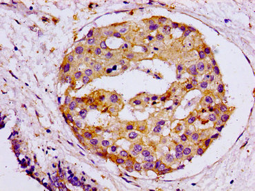IHC image of CSB-PA021871LA01HU diluted at 1:100 and staining in paraffin-embedded human breast cancer performed on a Leica BondTM system. After dewaxing and hydration, antigen retrieval was mediated by high pressure in a citrate buffer (pH 6.0). Section was blocked with 10% normal goat serum 30min at RT. Then primary antibody (1% BSA) was incubated at 4°C overnight. The primary is detected by a biotinylated secondary antibody and visualized using an HRP conjugated ABC system.