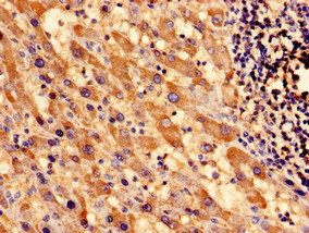 Immunocytochemistry analysis of human liver cancer using CSB-PA022392EA01HU at dilution of 1:100 Immunocytochemistry analysis of human liver cancer using CSB-PA022392EA01HU at dilution of 1:100