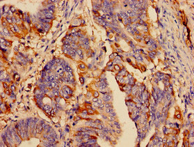 Immunohistochemistry analysis of human colon cancer using CSB-PA022723OJ01HU at dilution of 1:100