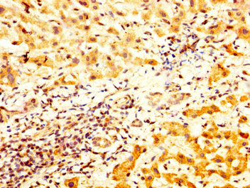 IHC image of CSB-PA023320LA01HU diluted at 1:800 and staining in paraffin-embedded human liver cancer performed on a Leica BondTM system. After dewaxing and hydration, antigen retrieval was mediated by high pressure in a citrate buffer (pH 6.0). Section was blocked with 10% normal goat serum 30min at RT. Then primary antibody (1% BSA) was incubated at 4°C overnight. The primary is detected by a biotinylated secondary antibody and visualized using an HRP conjugated SP system. IHC image of CSB-PA023320LA01HU diluted at 1:800 and staining in paraffin-embedded human liver cancer performed on a Leica BondTM system. After dewaxing and hydration, antigen retrieval was mediated by high pressure in a citrate buffer (pH 6.0). Section was blocked with 10% normal goat serum 30min at RT. Then primary antibody (1% BSA) was incubated at 4°C overnight. The primary is detected by a biotinylated secondary antibody and visualized using an HRP conjugated SP system.