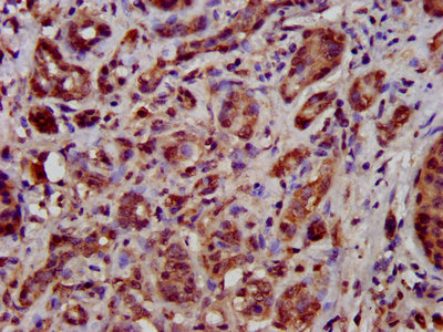 IHC image of CSB-PA023420LA01HU diluted at 1:500 and staining in paraffin-embedded human pancreatic cancer performed on a Leica BondTM system. After dewaxing and hydration, antigen retrieval was mediated by high pressure in a citrate buffer (pH 6.0). Section was blocked with 10% normal goat serum 30min at RT. Then primary antibody (1% BSA) was incubated at 4°C overnight. The primary is detected by a biotinylated secondary antibody and visualized using an HRP conjugated SP system.