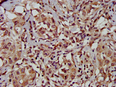 IHC image of CSB-PA023420LA01HU diluted at 1:500 and staining in paraffin-embedded human liver cancer performed on a Leica BondTM system. After dewaxing and hydration, antigen retrieval was mediated by high pressure in a citrate buffer (pH 6.0). Section was blocked with 10% normal goat serum 30min at RT. Then primary antibody (1% BSA) was incubated at 4°C overnight. The primary is detected by a biotinylated secondary antibody and visualized using an HRP conjugated SP system.