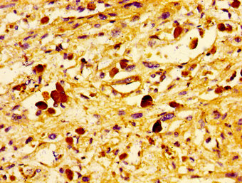Immunohistochemistry of paraffin-embedded human melanoma using CSB-PA025444LA01HU at dilution of 1:100 Immunohistochemistry of paraffin-embedded human melanoma using CSB-PA025444LA01HU at dilution of 1:100