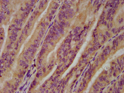 IHC image of CSB-PA025579LA01HU diluted at 1:200 and staining in paraffin-embedded human endometrial cancer performed on a Leica BondTM system. After dewaxing and hydration, antigen retrieval was mediated by high pressure in a citrate buffer (pH 6.0). Section was blocked with 10% normal goat serum 30min at RT. Then primary antibody (1% BSA) was incubated at 4°C overnight. The primary is detected by a biotinylated secondary antibody and visualized using an HRP conjugated SP system.