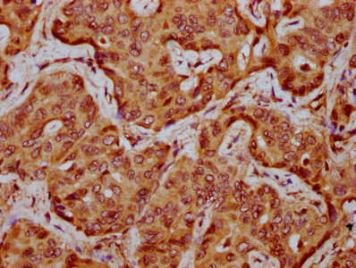 IHC image of CSB-PA025865LA01HU diluted at 1:300 and staining in paraffin-embedded human liver cancer performed on a Leica BondTM system. After dewaxing and hydration, antigen retrieval was mediated by high pressure in a citrate buffer (pH 6.0). Section was blocked with 10% normal goat serum 30min at RT. Then primary antibody (1% BSA) was incubated at 4°C overnight. The primary is detected by a biotinylated secondary antibody and visualized using an HRP conjugated SP system. IHC image of CSB-PA025865LA01HU diluted at 1:300 and staining in paraffin-embedded human liver cancer performed on a Leica BondTM system. After dewaxing and hydration, antigen retrieval was mediated by high pressure in a citrate buffer (pH 6.0). Section was blocked with 10% normal goat serum 30min at RT. Then primary antibody (1% BSA) was incubated at 4°C overnight. The primary is detected by a biotinylated secondary antibody and visualized using an HRP conjugated SP system.