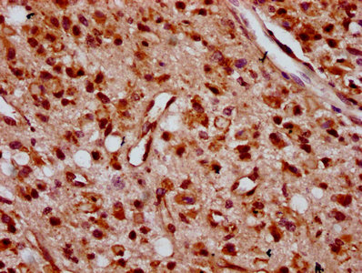 IHC image of CSB-PA026703LA01HU diluted at 1:400 and staining in paraffin-embedded human glioma performed on a Leica BondTM system. After dewaxing and hydration, antigen retrieval was mediated by high pressure in a citrate buffer (pH 6.0). Section was blocked with 10% normal goat serum 30min at RT. Then primary antibody (1% BSA) was incubated at 4°C overnight. The primary is detected by a biotinylated secondary antibody and visualized using an HRP conjugated SP system.