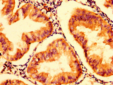 IHC image of CSB-PA12259A0Rb diluted at 1:300 and staining in paraffin-embedded human endometrial cancer performed on a Leica BondTM system. After dewaxing and hydration, antigen retrieval was mediated by high pressure in a citrate buffer (pH 6.0). Section was blocked with 10% normal goat serum 30min at RT. Then primary antibody (1% BSA) was incubated at 4°C overnight. The primary is detected by a biotinylated secondary antibody and visualized using an HRP conjugated SP system.