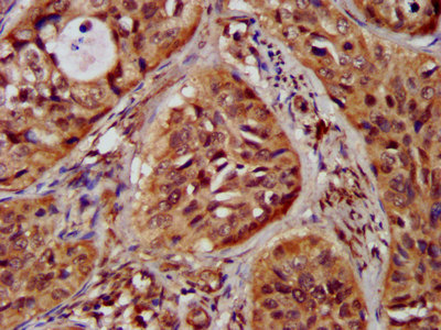 IHC image of CSB-PA612121LA01HU diluted at 1:300 and staining in paraffin-embedded human cervical cancer performed on a Leica BondTM system. After dewaxing and hydration, antigen retrieval was mediated by high pressure in a citrate buffer (pH 6.0). Section was blocked with 10% normal goat serum 30min at RT. Then primary antibody (1% BSA) was incubated at 4°C overnight. The primary is detected by a biotinylated secondary antibody and visualized using an HRP conjugated SP system.