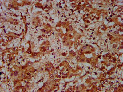 IHC image of CSB-PA617942LA01HU diluted at 1:600 and staining in paraffin-embedded human liver cancer performed on a Leica BondTM system. After dewaxing and hydration, antigen retrieval was mediated by high pressure in a citrate buffer (pH 6.0). Section was blocked with 10% normal goat serum 30min at RT. Then primary antibody (1% BSA) was incubated at 4°C overnight. The primary is detected by a biotinylated secondary antibody and visualized using an HRP conjugated SP system.