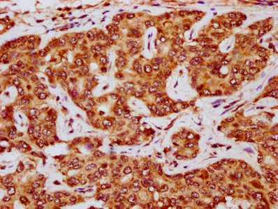 IHC image of CSB-PA624021LA01HU diluted at 1:200 and staining in paraffin-embedded human liver cancer performed on a Leica BondTM system. After dewaxing and hydration, antigen retrieval was mediated by high pressure in a citrate buffer (pH 6.0). Section was blocked with 10% normal goat serum 30min at RT. Then primary antibody (1% BSA) was incubated at 4°C overnight. The primary is detected by a biotinylated secondary antibody and visualized using an HRP conjugated SP system.