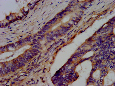 IHC image of CSB-PA773793LA01HU diluted at 1:300 and staining in paraffin-embedded human colon cancer performed on a Leica BondTM system. After dewaxing and hydration, antigen retrieval was mediated by high pressure in a citrate buffer (pH 6.0). Section was blocked with 10% normal goat serum 30min at RT. Then primary antibody (1% BSA) was incubated at 4°C overnight. The primary is detected by a biotinylated secondary antibody and visualized using an HRP conjugated SP system.