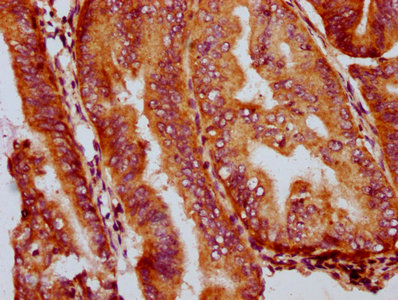 IHC image of CSB-PA850415LA01HU diluted at 1:400 and staining in paraffin-embedded human endometrial cancer performed on a Leica BondTM system. After dewaxing and hydration, antigen retrieval was mediated by high pressure in a citrate buffer (pH 6.0). Section was blocked with 10% normal goat serum 30min at RT. Then primary antibody (1% BSA) was incubated at 4°C overnight. The primary is detected by a biotinylated secondary antibody and visualized using an HRP conjugated SP system.