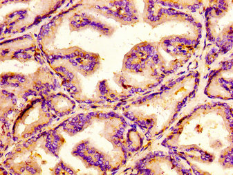 IHC image of CSB-PA850838LA01HU diluted at 1:100 and staining in paraffin-embedded human prostate tissue performed on a Leica BondTM system. After dewaxing and hydration, antigen retrieval was mediated by high pressure in a citrate buffer (pH 6.0). Section was blocked with 10% normal goat serum 30min at RT. Then primary antibody (1% BSA) was incubated at 4°C overnight. The primary is detected by a biotinylated secondary antibody and visualized using an HRP conjugated SP system. IHC image of CSB-PA850838LA01HU diluted at 1:100 and staining in paraffin-embedded human prostate tissue performed on a Leica BondTM system. After dewaxing and hydration, antigen retrieval was mediated by high pressure in a citrate buffer (pH 6.0). Section was blocked with 10% normal goat serum 30min at RT. Then primary antibody (1% BSA) was incubated at 4°C overnight. The primary is detected by a biotinylated secondary antibody and visualized using an HRP conjugated SP system.