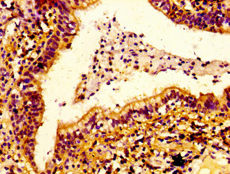 IHC image of CSB-PA857020EA01HU diluted at 1:100 and staining in paraffin-embedded human lung cancer performed on a Leica BondTM system. After dewaxing and hydration, antigen retrieval was mediated by high pressure in a citrate buffer (pH 6.0). Section was blocked with 10% normal goat serum 30min at RT. Then primary antibody (1% BSA) was incubated at 4°C overnight. The primary is detected by a biotinylated secondary antibody and visualized using an HRP conjugated SP system.