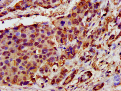 IHC image of CSB-PA872487LA01HU diluted at 1:400 and staining in paraffin-embedded human pancreatic cancer performed on a Leica BondTM system. After dewaxing and hydration, antigen retrieval was mediated by high pressure in a citrate buffer (pH 6.0). Section was blocked with 10% normal goat serum 30min at RT. Then primary antibody (1% BSA) was incubated at 4°C overnight. The primary is detected by a biotinylated secondary antibody and visualized using an HRP conjugated SP system.