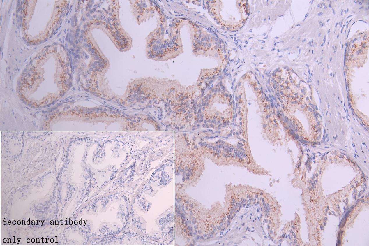 Immunohistochemistry of paraffin-embedded human prostate cancer using CSB-PA872494LA01HU at dilution of 1:100