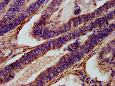 IHC image of CSB-PA875681LA01HU diluted at 1:1000 and staining in paraffin-embedded human colon cancer performed on a Leica BondTM system. After dewaxing and hydration, antigen retrieval was mediated by high pressure in a citrate buffer (pH 6.0). Section was blocked with 10% normal goat serum 30min at RT. Then primary antibody (1% BSA) was incubated at 4°C overnight. The primary is detected by a biotinylated secondary antibody and visualized using an HRP conjugated SP system. IHC image of CSB-PA875681LA01HU diluted at 1:1000 and staining in paraffin-embedded human colon cancer performed on a Leica BondTM system. After dewaxing and hydration, antigen retrieval was mediated by high pressure in a citrate buffer (pH 6.0). Section was blocked with 10% normal goat serum 30min at RT. Then primary antibody (1% BSA) was incubated at 4°C overnight. The primary is detected by a biotinylated secondary antibody and visualized using an HRP conjugated SP system.