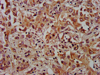 IHC image of CSB-PA875681LA01HU diluted at 1:1000 and staining in paraffin-embedded human liver cancer performed on a Leica BondTM system. After dewaxing and hydration, antigen retrieval was mediated by high pressure in a citrate buffer (pH 6.0). Section was blocked with 10% normal goat serum 30min at RT. Then primary antibody (1% BSA) was incubated at 4°C overnight. The primary is detected by a biotinylated secondary antibody and visualized using an HRP conjugated SP system. IHC image of CSB-PA875681LA01HU diluted at 1:1000 and staining in paraffin-embedded human liver cancer performed on a Leica BondTM system. After dewaxing and hydration, antigen retrieval was mediated by high pressure in a citrate buffer (pH 6.0). Section was blocked with 10% normal goat serum 30min at RT. Then primary antibody (1% BSA) was incubated at 4°C overnight. The primary is detected by a biotinylated secondary antibody and visualized using an HRP conjugated SP system.