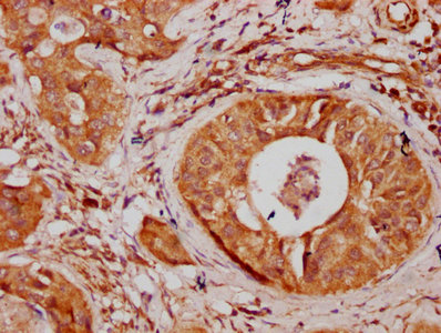 IHC image of CSB-PA896538LA01HU diluted at 1:300 and staining in paraffin-embedded human cervical cancer performed on a Leica BondTM system. After dewaxing and hydration, antigen retrieval was mediated by high pressure in a citrate buffer (pH 6.0). Section was blocked with 10% normal goat serum 30min at RT. Then primary antibody (1% BSA) was incubated at 4°C overnight. The primary is detected by a biotinylated secondary antibody and visualized using an HRP conjugated SP system.