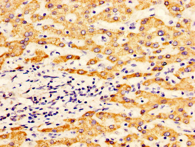 IHC image of CSB-PA001577LA01HU diluted at 1:400 and staining in paraffin-embedded human liver cancer performed on a Leica BondTM system. After dewaxing and hydration, antigen retrieval was mediated by high pressure in a citrate buffer (pH 6.0). Section was blocked with 10% normal goat serum 30min at RT. Then primary antibody (1% BSA) was incubated at 4°C overnight. The primary is detected by a biotinylated secondary antibody and visualized using an HRP conjugated SP system.