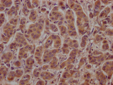 IHC image of CSB-PA002272LA01HU diluted at 1:100 and staining in paraffin-embedded human breast cancer performed on a Leica BondTM system. After dewaxing and hydration, antigen retrieval was mediated by high pressure in a citrate buffer (pH 6.0). Section was blocked with 10% normal goat serum 30min at RT. Then primary antibody (1% BSA) was incubated at 4°C overnight. The primary is detected by a Goat anti-rabbit polymer IgG labeled by HRP and visualized using 0.05% DAB. IHC image of CSB-PA002272LA01HU diluted at 1:100 and staining in paraffin-embedded human breast cancer performed on a Leica BondTM system. After dewaxing and hydration, antigen retrieval was mediated by high pressure in a citrate buffer (pH 6.0). Section was blocked with 10% normal goat serum 30min at RT. Then primary antibody (1% BSA) was incubated at 4°C overnight. The primary is detected by a Goat anti-rabbit polymer IgG labeled by HRP and visualized using 0.05% DAB.
