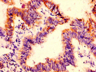 IHC image of CSB-PA008545EA01HU diluted at 1:500 and staining in paraffin-embedded human colon cancer performed on a Leica BondTM system. After dewaxing and hydration, antigen retrieval was mediated by high pressure in a citrate buffer (pH 6.0). Section was blocked with 10% normal goat serum 30min at RT. Then primary antibody (1% BSA) was incubated at 4°C overnight. The primary is detected by a biotinylated secondary antibody and visualized using an HRP conjugated SP system.