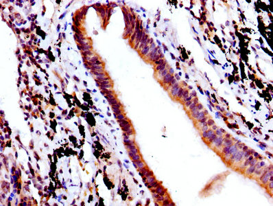 IHC image of CSB-PA008545EA01HU diluted at 1:500 and staining in paraffin-embedded human lung cancer performed on a Leica BondTM system. After dewaxing and hydration, antigen retrieval was mediated by high pressure in a citrate buffer (pH 6.0). Section was blocked with 10% normal goat serum 30min at RT. Then primary antibody (1% BSA) was incubated at 4°C overnight. The primary is detected by a biotinylated secondary antibody and visualized using an HRP conjugated SP system.