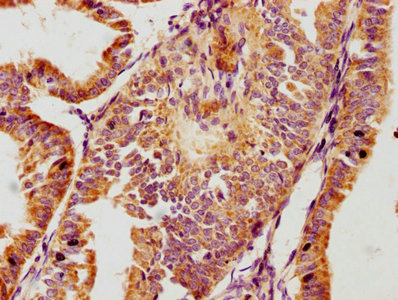 IHC image of CSB-PA009721LA01HU diluted at 1:100 and staining in paraffin-embedded human endometrial cancer performed on a Leica BondTM system. After dewaxing and hydration, antigen retrieval was mediated by high pressure in a citrate buffer (pH 6.0). Section was blocked with 10% normal goat serum 30min at RT. Then primary antibody (1% BSA) was incubated at 4°C overnight. The primary is detected by a biotinylated secondary antibody and visualized using an HRP conjugated SP system.