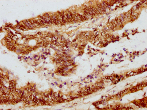IHC image of CSB-PA010380OA01nphHU diluted at 1:10 and staining in paraffin-embedded human colon cancer performed on a Leica BondTM system. After dewaxing and hydration, antigen retrieval was mediated by high pressure in a citrate buffer (pH 6.0). Section was blocked with 10% normal goat serum 30min at RT. Then primary antibody (1% BSA) was incubated at 4°C overnight. The primary is detected by a biotinylated secondary antibody and visualized using an HRP conjugated SP system.