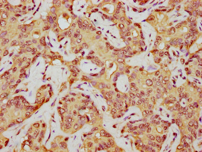 IHC image of CSB-PA010380OA45nacHU diluted at 1:5 and staining in paraffin-embedded human liver cancer performed on a Leica BondTM system. After dewaxing and hydration, antigen retrieval was mediated by high pressure in a citrate buffer (pH 6.0). Section was blocked with 10% normal goat serum 30min at RT. Then primary antibody (1% BSA) was incubated at 4°C overnight. The primary is detected by a biotinylated secondary antibody and visualized using an HRP conjugated SP system.