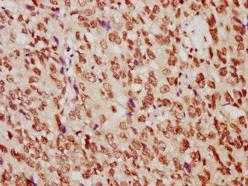 IHC image of CSB-PA010389PA29nme1HU diluted at 1:10 and staining in paraffin-embedded human ovarian cancer performed on a Leica BondTM system. After dewaxing and hydration, antigen retrieval was mediated by high pressure in a citrate buffer (pH 6.0). Section was blocked with 10% normal goat serum 30min at RT. Then primary antibody (1% BSA) was incubated at 4°C overnight. The primary is detected by a biotinylated secondary antibody and visualized using an HRP conjugated SP system.