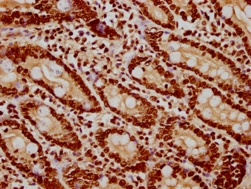IHC image of CSB-PA010418PA122nsucHU diluted at 1:20 and staining in paraffin-embedded human small intestine tissue performed on a Leica BondTM system. After dewaxing and hydration, antigen retrieval was mediated by high pressure in a citrate buffer (pH 6.0). Section was blocked with 10% normal goat serum 30min at RT. Then primary antibody (1% BSA) was incubated at 4°C overnight. The primary is detected by a biotinylated secondary antibody and visualized using an HRP conjugated SP system. IHC image of CSB-PA010418PA122nsucHU diluted at 1:20 and staining in paraffin-embedded human small intestine tissue performed on a Leica BondTM system. After dewaxing and hydration, antigen retrieval was mediated by high pressure in a citrate buffer (pH 6.0). Section was blocked with 10% normal goat serum 30min at RT. Then primary antibody (1% BSA) was incubated at 4°C overnight. The primary is detected by a biotinylated secondary antibody and visualized using an HRP conjugated SP system.