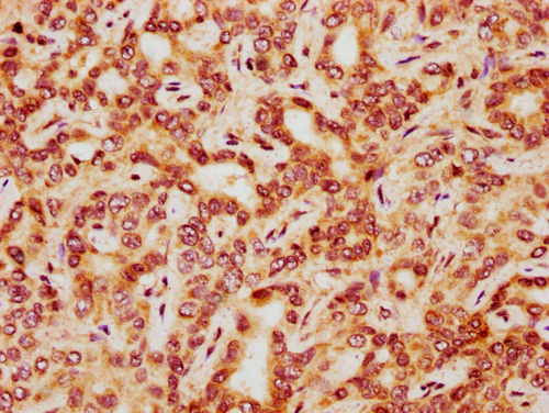 IHC image of CSB-PA010418PA41nphHU diluted at 1:20 and staining in paraffin-embedded human liver cancer performed on a Leica BondTM system. After dewaxing and hydration, antigen retrieval was mediated by high pressure in a citrate buffer (pH 6.0). Section was blocked with 10% normal goat serum 30min at RT. Then primary antibody (1% BSA) was incubated at 4°C overnight. The primary is detected by a biotinylated secondary antibody and visualized using an HRP conjugated SP system. IHC image of CSB-PA010418PA41nphHU diluted at 1:20 and staining in paraffin-embedded human liver cancer performed on a Leica BondTM system. After dewaxing and hydration, antigen retrieval was mediated by high pressure in a citrate buffer (pH 6.0). Section was blocked with 10% normal goat serum 30min at RT. Then primary antibody (1% BSA) was incubated at 4°C overnight. The primary is detected by a biotinylated secondary antibody and visualized using an HRP conjugated SP system.