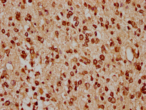 IHC image of CSB-PA010429PA91nacHU diluted at 1:20 and staining in paraffin-embedded human glioma cancer performed on a Leica BondTM system. After dewaxing and hydration, antigen retrieval was mediated by high pressure in a citrate buffer (pH 6.0). Section was blocked with 10% normal goat serum 30min at RT. Then primary antibody (1% BSA) was incubated at 4°C overnight. The primary is detected by a biotinylated secondary antibody and visualized using an HRP conjugated SP system. IHC image of CSB-PA010429PA91nacHU diluted at 1:20 and staining in paraffin-embedded human glioma cancer performed on a Leica BondTM system. After dewaxing and hydration, antigen retrieval was mediated by high pressure in a citrate buffer (pH 6.0). Section was blocked with 10% normal goat serum 30min at RT. Then primary antibody (1% BSA) was incubated at 4°C overnight. The primary is detected by a biotinylated secondary antibody and visualized using an HRP conjugated SP system.