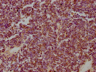 IHC image of CSB-PA010847LA01HU diluted at 1:300 and staining in paraffin-embedded human lung cancer performed on a Leica BondTM system. After dewaxing and hydration, antigen retrieval was mediated by high pressure in a citrate buffer (pH 6.0). Section was blocked with 10% normal goat serum 30min at RT. Then primary antibody (1% BSA) was incubated at 4°C overnight. The primary is detected by a biotinylated secondary antibody and visualized using an HRP conjugated SP system.